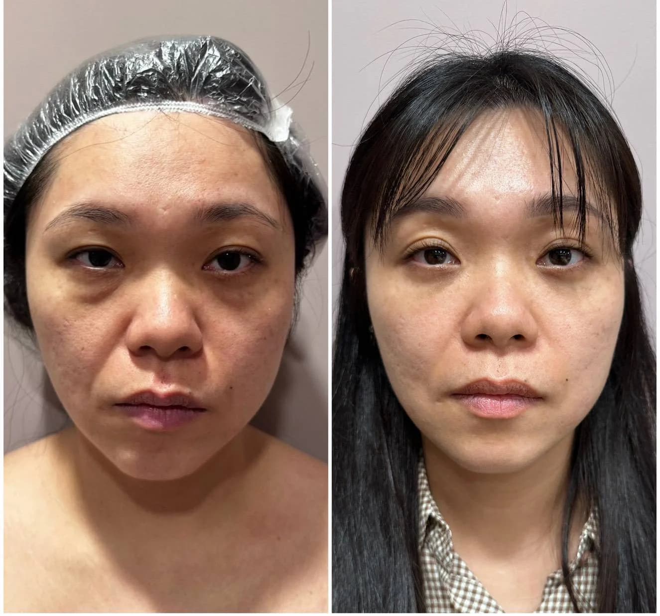 眼袋與眼周年輕化