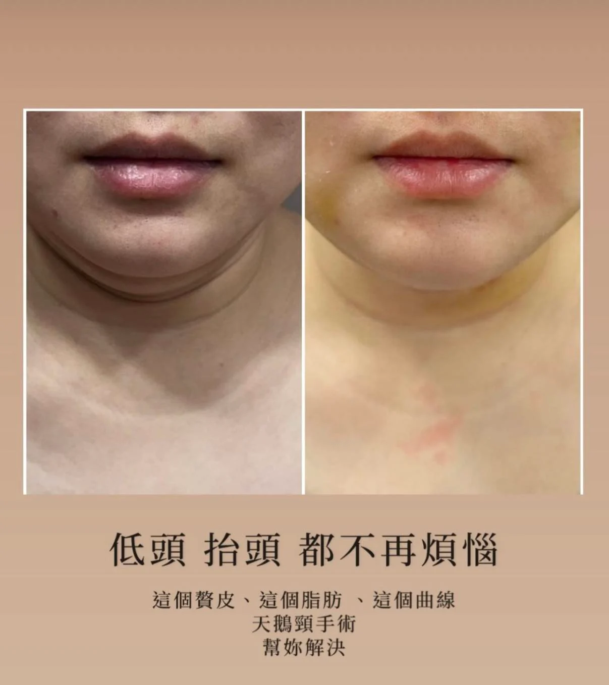 深筋膜拉皮與拉提