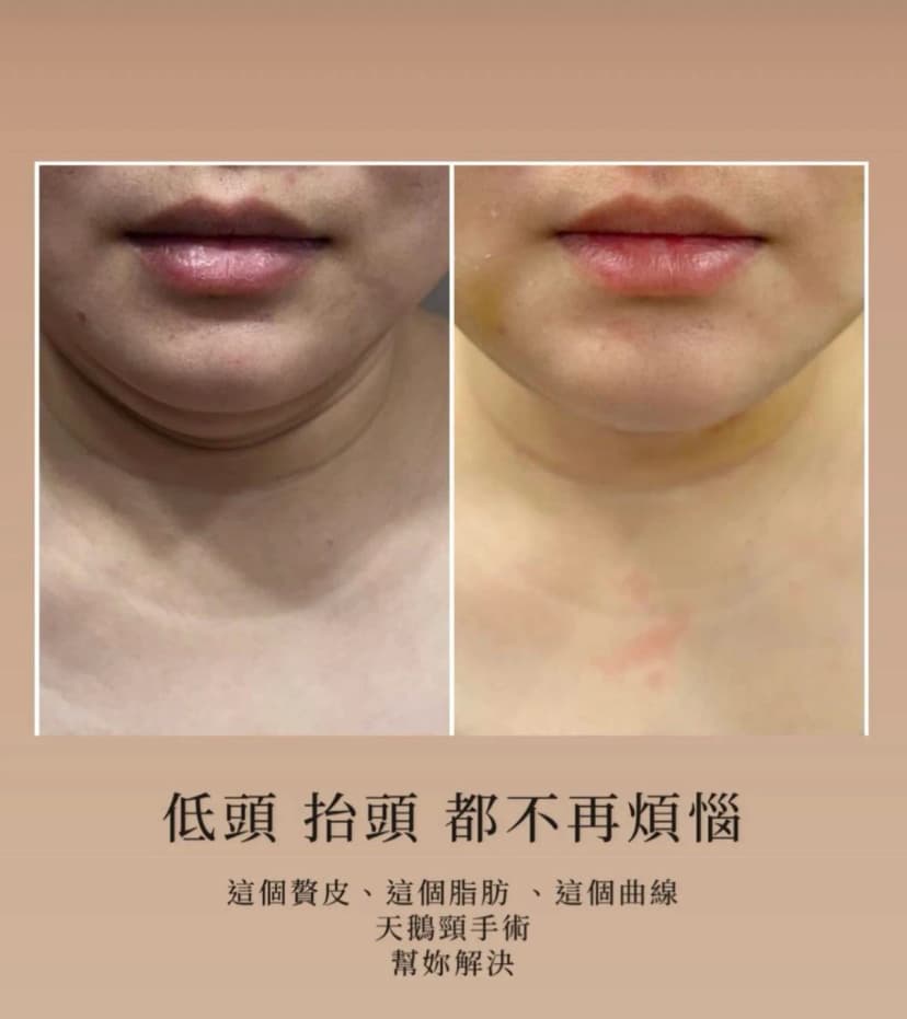 下顎線與頸部輪廓