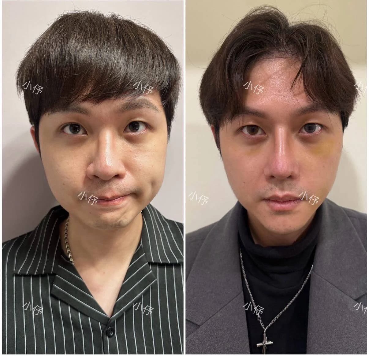 微整型與全臉抗老